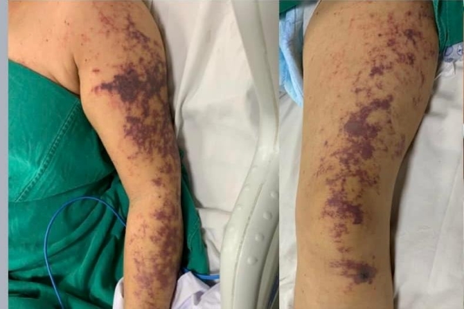 Khuyến cáo phòng chống bệnh liên cầu lợn ở người