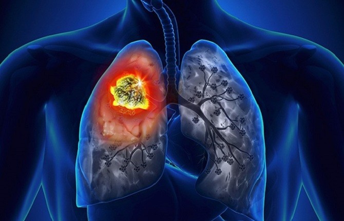 Nguy cơ mắc nhiều loại ung thư từ thuốc lá