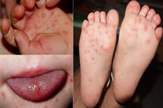 Bệnh Tay chân miệng dấu hiệu nhận biết và cách phòng bệnh
