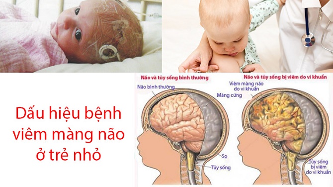 Thận trọng với bệnh viêm màng não do não mô cầu